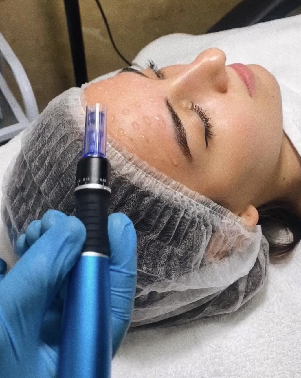 Microneedling